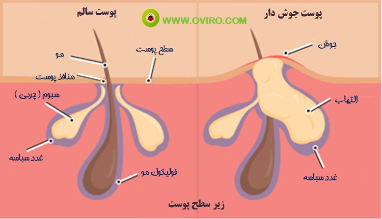 محلول ضد جوش اریترومایسین - تفاوت پوست سالم و جوش دار