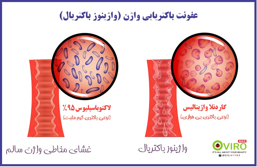 راه درمان عفونت باکتریایی واژن