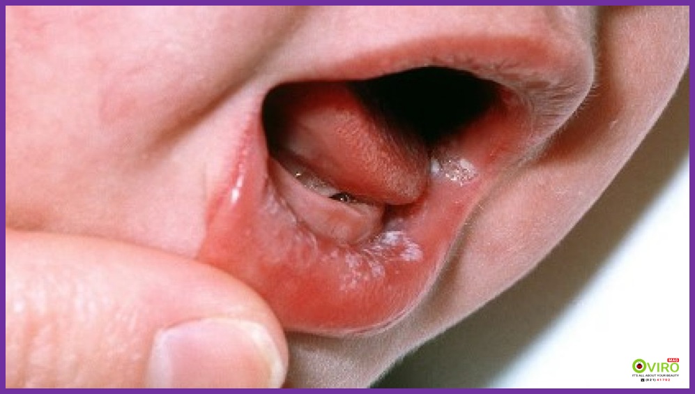 برفک دهان (Thrush) یا عفونت مخمر اوروفارنکس (Oropharyngeal Candidiasis)