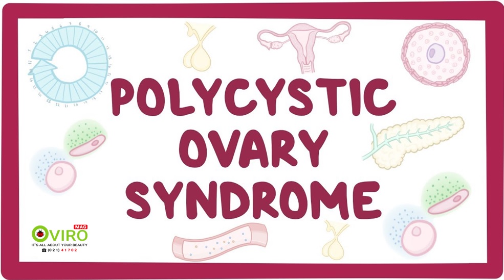 سندروم تخمدان پلی کیستیک | PolyCystic Ovary Syndrome | قرص مکمل گیاهی ویتاگنوس