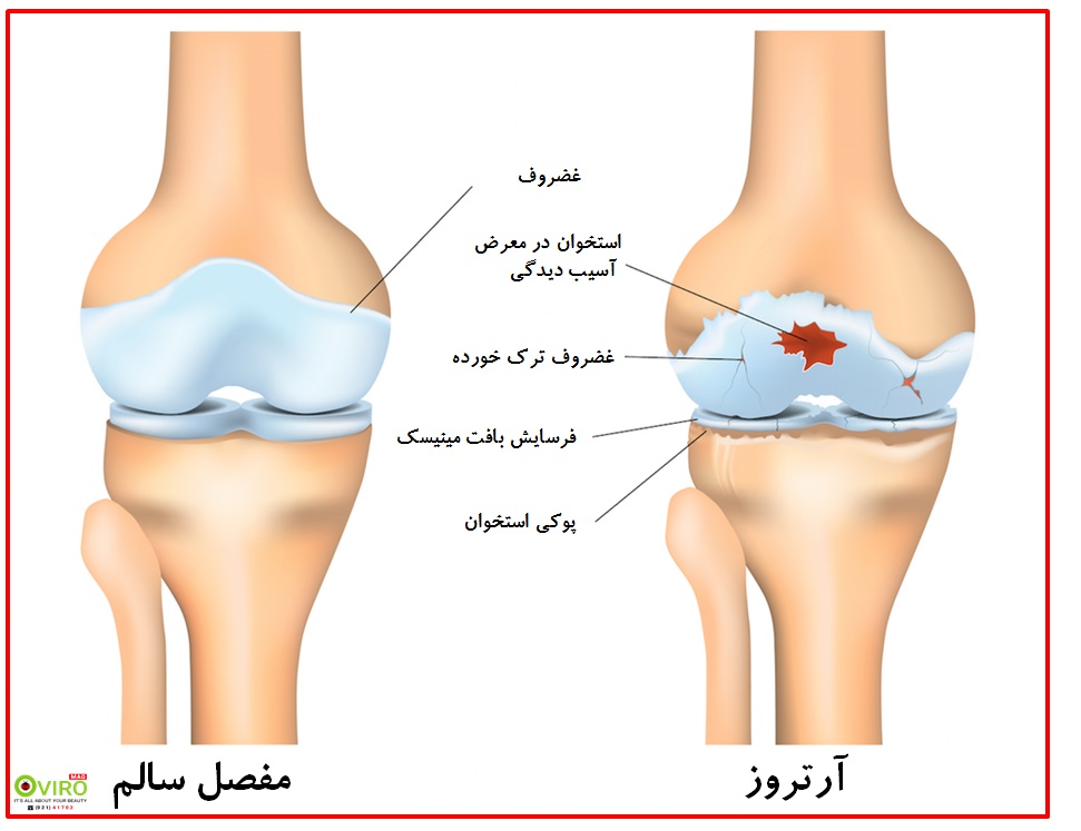 آرتروز