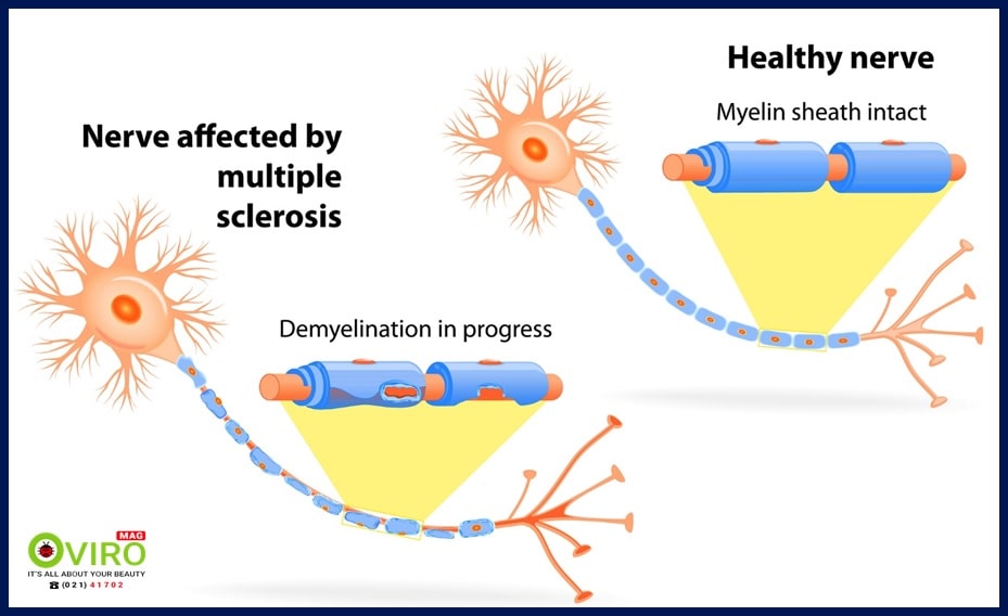 بیماری اسکلروز چندگانه | مولتیپل اسکلروز | Multiple Sclerosis | اِم اِس