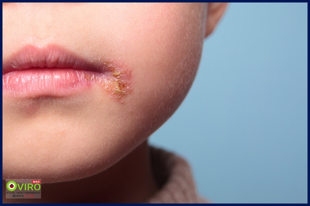 زرد زخم | Impetigo | علت ایجاد زرد زخم | درمان زرد زخم | علائم زرد زخم