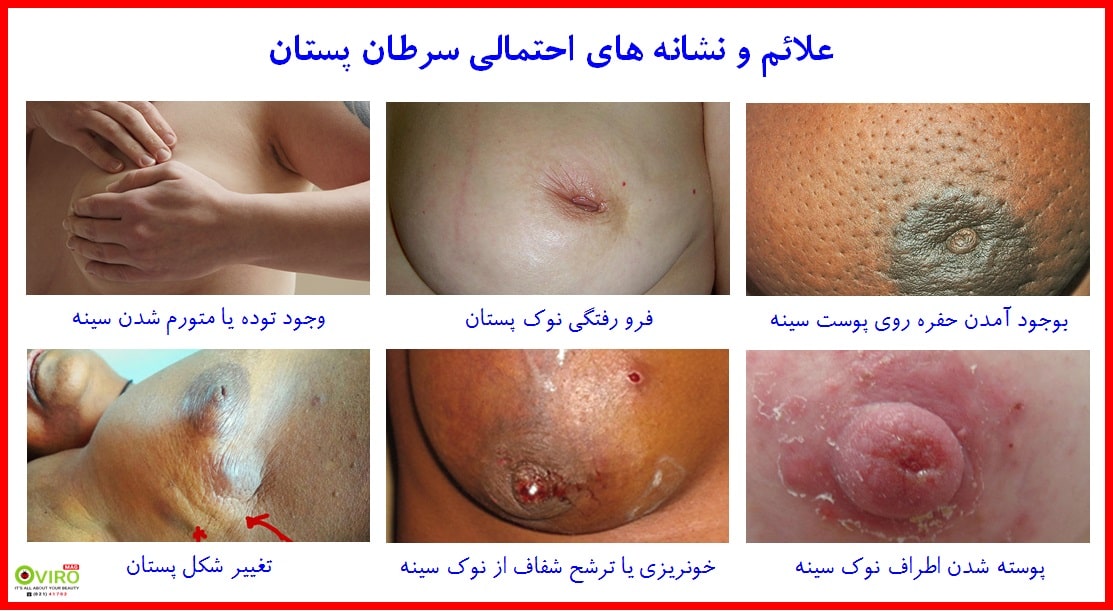 سرطان پستان | سرطان سینه | Breast cancer | نشانه های سرطان پستان