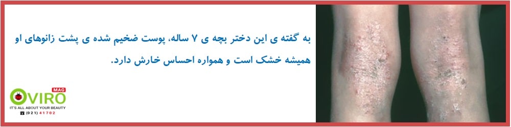 درماتیت آتوپیک نوزادان | درماتیت آتوپیک کودکان | درماتیت آتوپیک بزرگسالان | اگزما آتوپیک