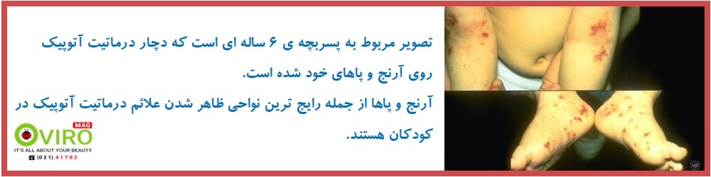 درماتیت آتوپیک نوزادان | درماتیت آتوپیک کودکان | درماتیت آتوپیک بزرگسالان | اگزما آتوپیک