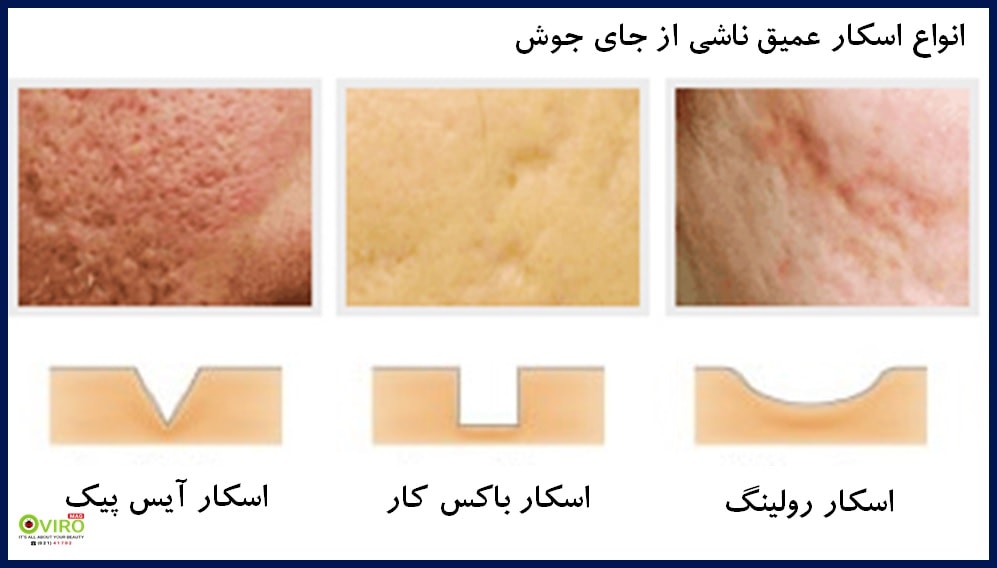 درمان لک های ناشی از جای جوش | انواع هایپرپیگمنتیشن | انواع آکنه اسکار های دائمی