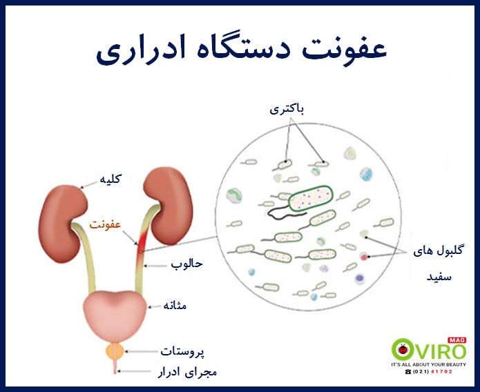 انواع عفونت های ادراری | علائم عفونت ادراری | علائم عفونت های غیر ادراری | اویرومگ