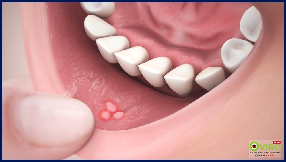 آفت دهان - زخم کانکر: علت، دلیل، راه های درمان، تفاوت با تبخال | اویرومگ
