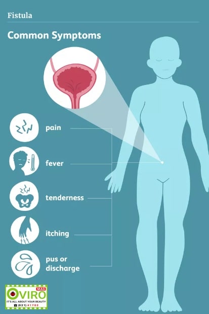 درمان فیستول | علائم فیستول | تشخیص فیستول | دستگاه تناسلی | مقعدی