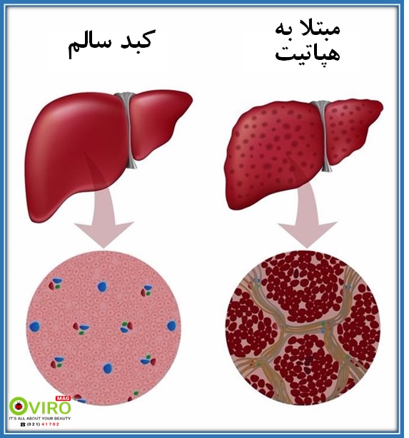 عوارض کبدی هپاتیت