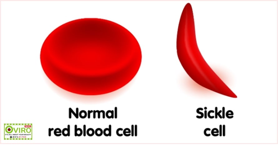بیماری سلول داسی شکل / کم خونی داسی شکل : علت ، علائم ، انواع ، درمان | اختلال ژنتیکی