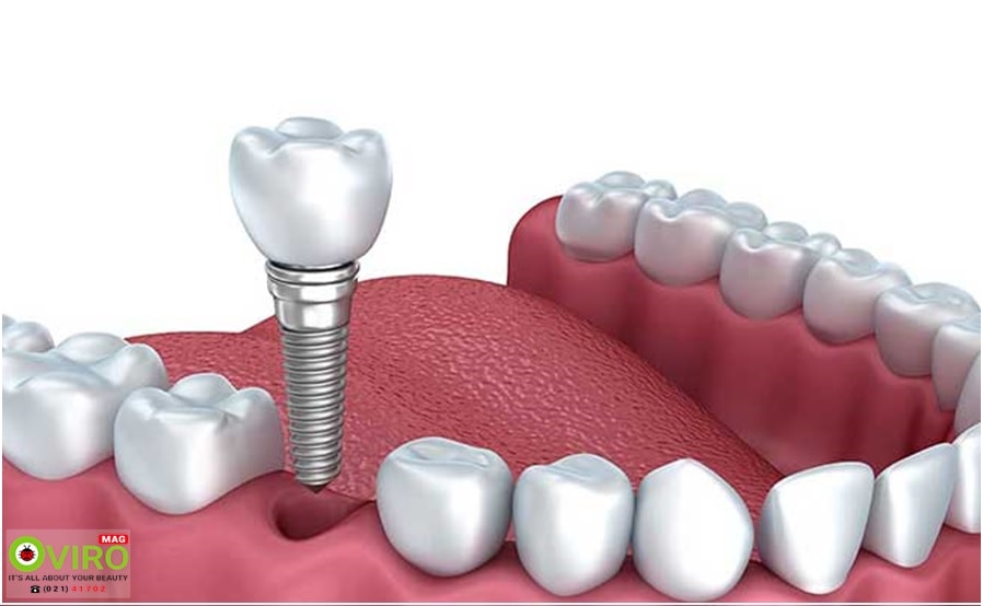 مشکلات جراحی ایمپلنت دندان: عوارض، علائم، خطرات، مراقبت و...