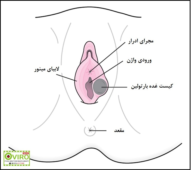 کیست بارتولین : علت - علائم - درمان | عفونت باکتریایی | سوزاک | کلامیدیا