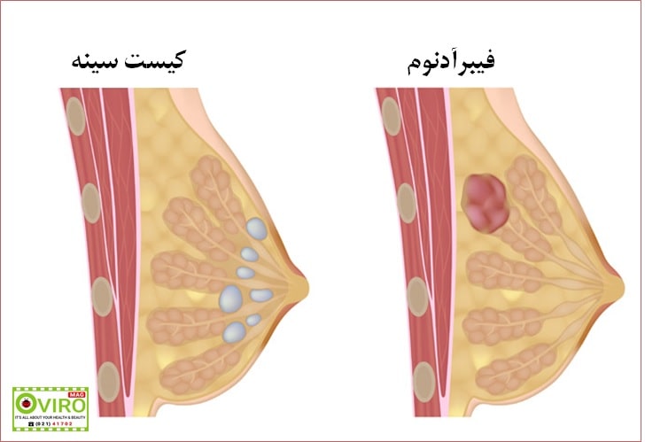 توده سینه (غده در سینه) : علت - ارزیابی - تشخیص - درمان | کیست پستان | فیبروآدنوم