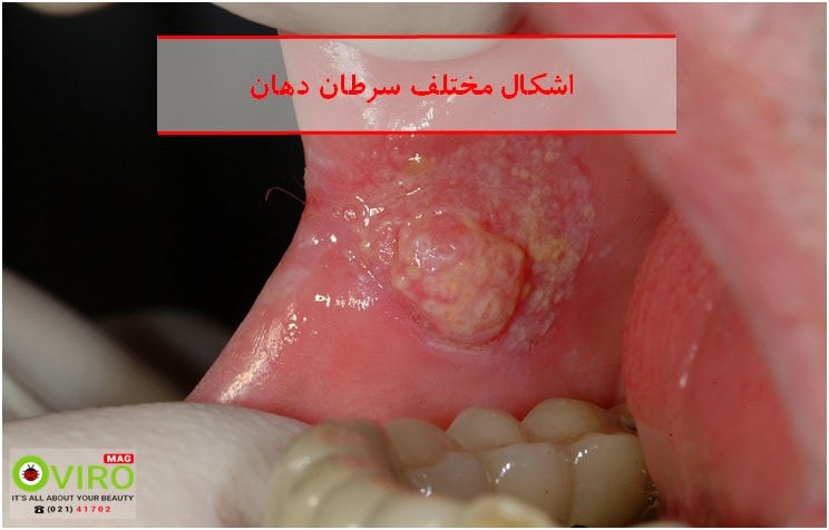 اشکال مختلف سرطان دهان - علائم و تفاوت سرطان دهان با دیگر بیماری های دهانی