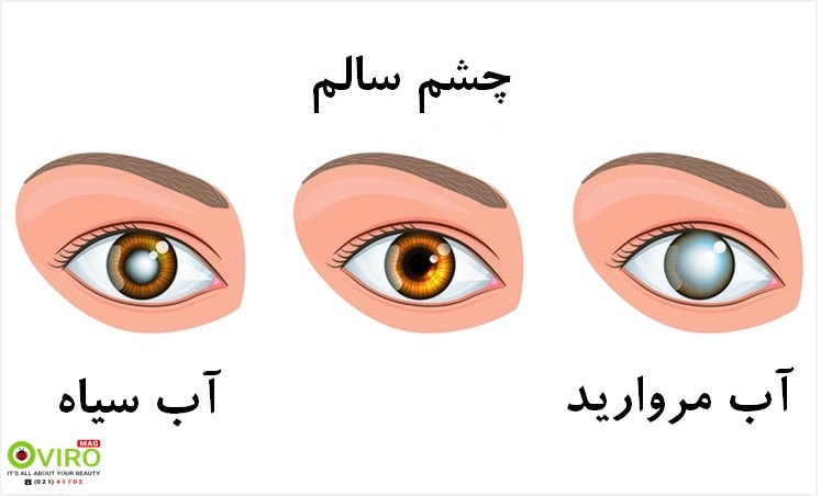 تفاوت آب سیاه (Glaucoma) و آب مروارید (Cataracts): علائم، درمان، تاثیر بر بینایی