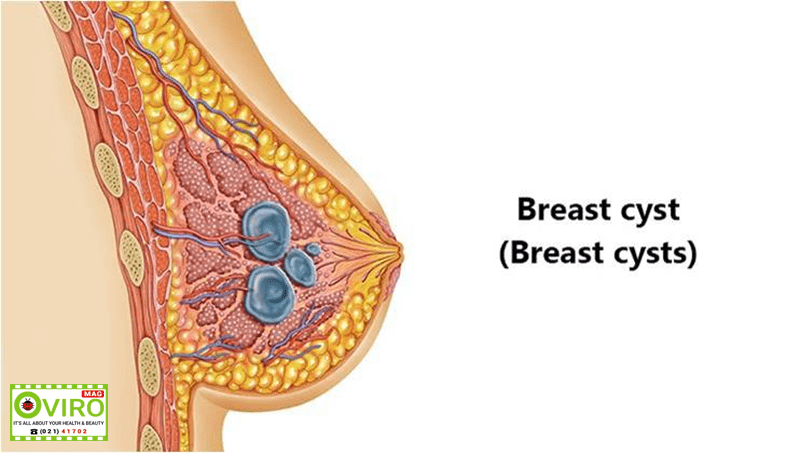 کیست پستان : انواع - علت - علائم - تشخیص - درمان | توده غیر سرطانی