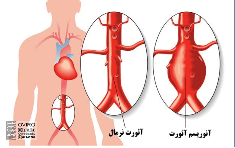 آنوریسم آئورت شکمی (AAA) : علائم - عوامل خطر - درمان | بیرون زدگی و ورم آئورت در شکم