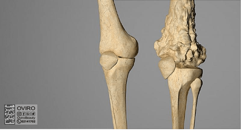 درمان سرطان استخوان : جراحی - شیمی درمانی - پرتودرمانی | عوارض درمان ها