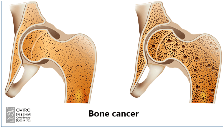 علائم و علت سرطان استخوان | درد استخوان شایع ترین علامت بیماری