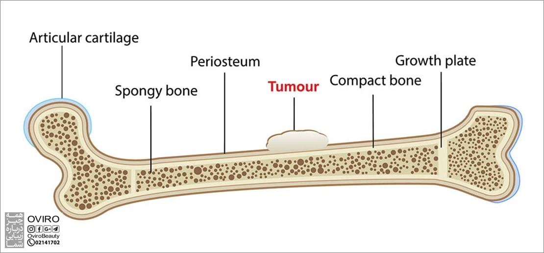 سرطان استخوان چیست ؟ انواع : استئوسارکوما - سارکوم یوئینگ - کندروسارکوم
