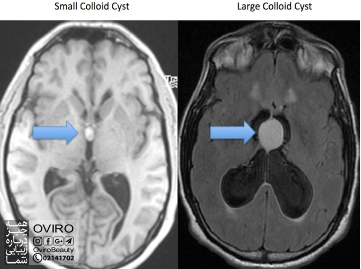 انواع کیست مغز : علائم و درمان (جراحی) | کیست آراکنوئید - پینه آل - کلوئید - درموئید