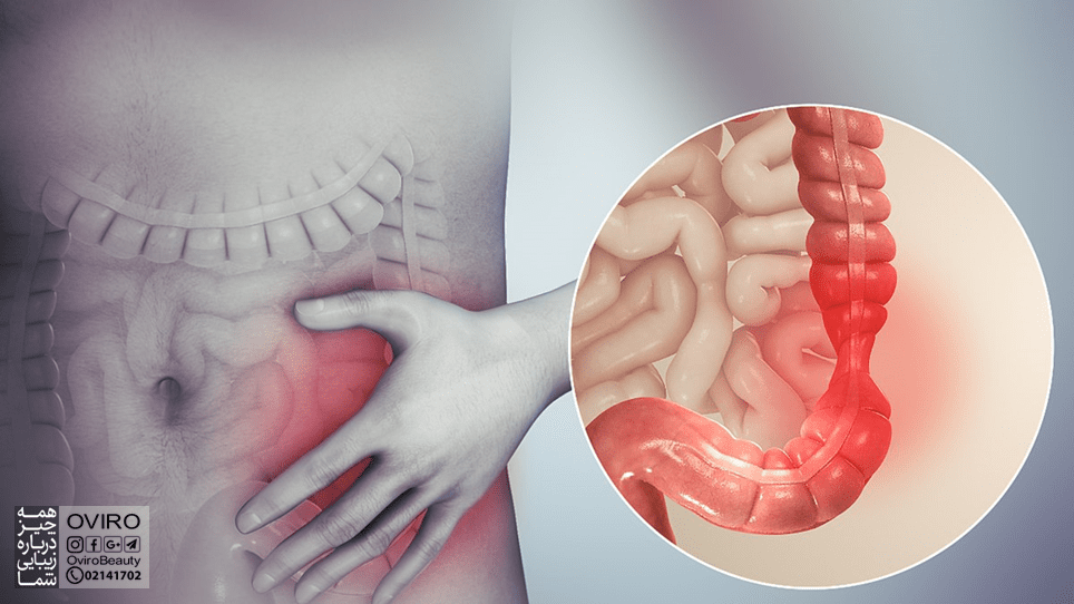 حمله IBS / سندروم روده تحریک پذیر : علائم - علت - درمان - پیشگیری