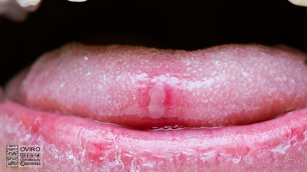 زخم زبان / زخم شانکر : علت - علائم - تشخیص - درمان خانگی و پزشکی