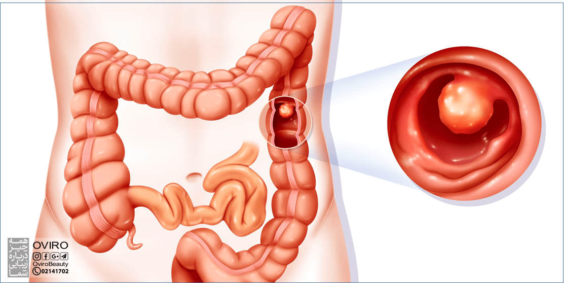 پولیپ روده بزرگ یا رکتوم چیست؟ اشکال - انواع - درمان - در کودکان و بزرگسالان
