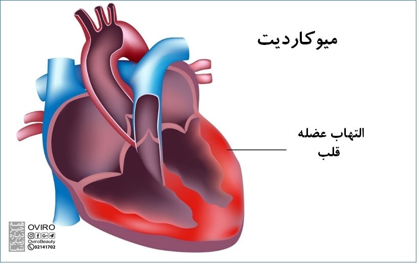 میوکاردیت / التهاب عضله قلب : علائم - علت - درمان - تشخیص - پیشگیری - عوارض