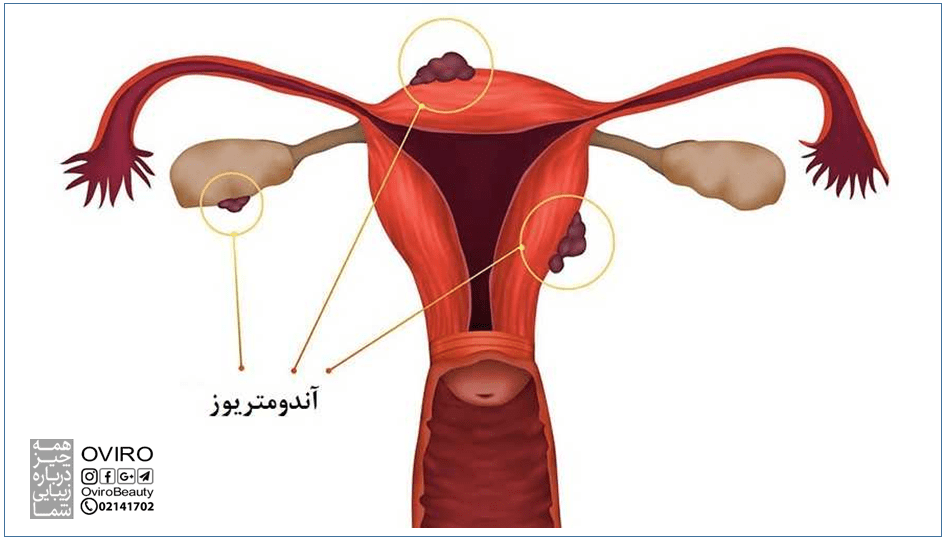 اندومتریوز : علائم - علت - عوامل خطر - درمان پزشکی - تشخیص - رژیم غذایی