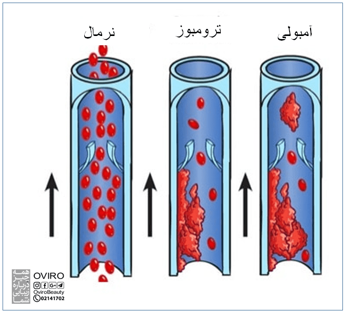 تفاوت ترومبوز و آمبولی : علائم - علت - عوامل خطر - پیشگیری - عوارض - درمان 