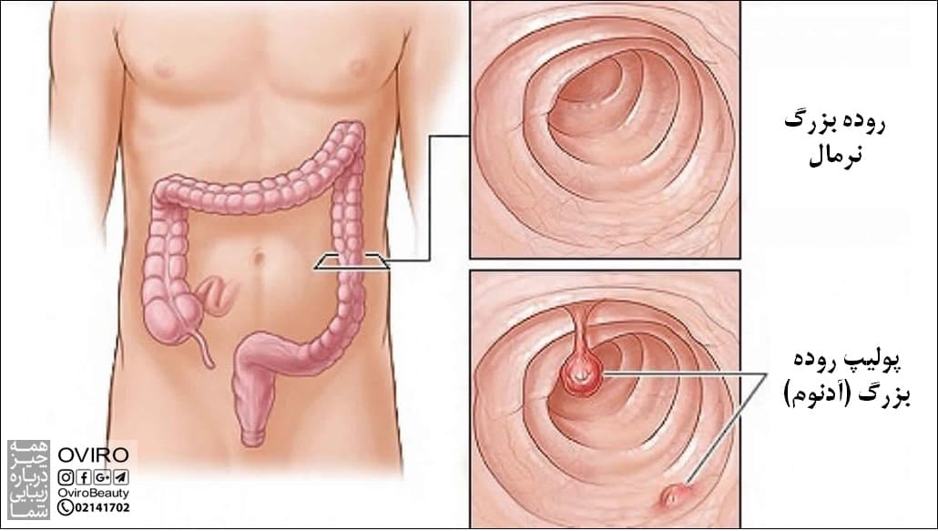 پولیپ آدنوماتوز روده / پولیپ آدنوم : علت - عوامل خطر - علائم - تشخیص - درمان