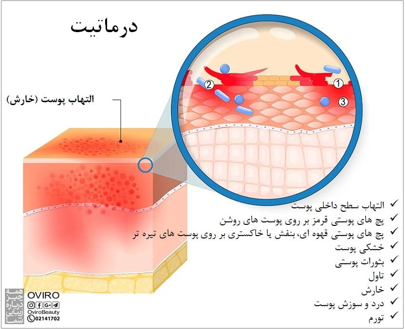 درماتیت : انواع - علائم و درمان | التهاب پوست | شوره سر - درماتیت تماسی - آتوپیک