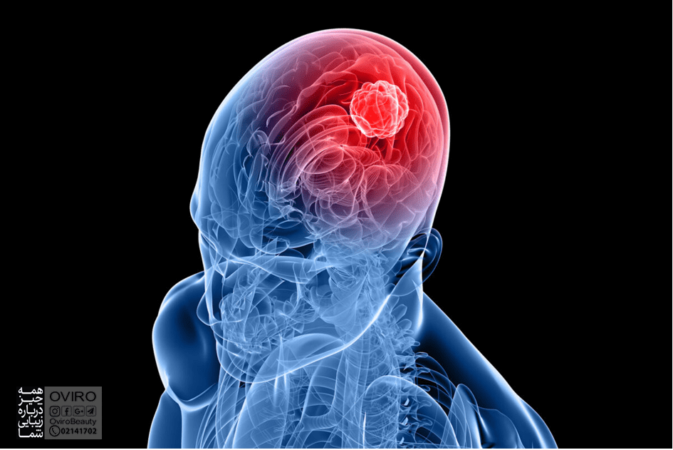 گلیوما: انواع، علائم و درمان | گلیوما چیست | انواع تومور مغزی | درمان گلیوما