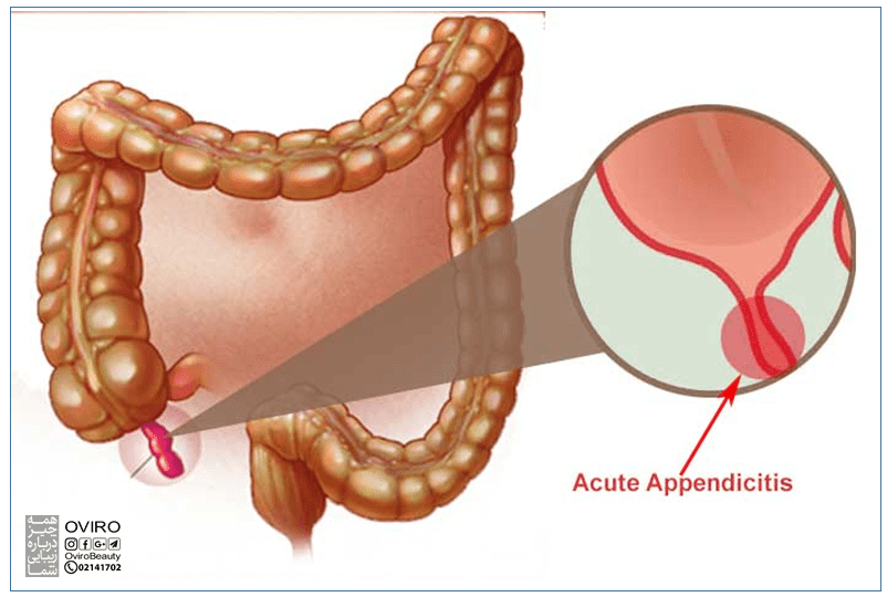 آپاندیسیت حاد در کودکان و بزرگسالان - علائم - علت - تشخیص - درمان - عوارض