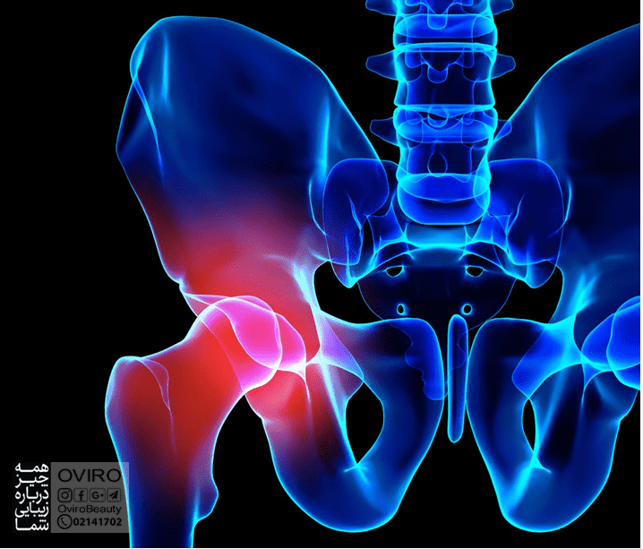 درد لگن هنگام راه رفتن : علت و پیشگیری | آسیب عضلات و مفصل - درد استخوان - درد عصبی