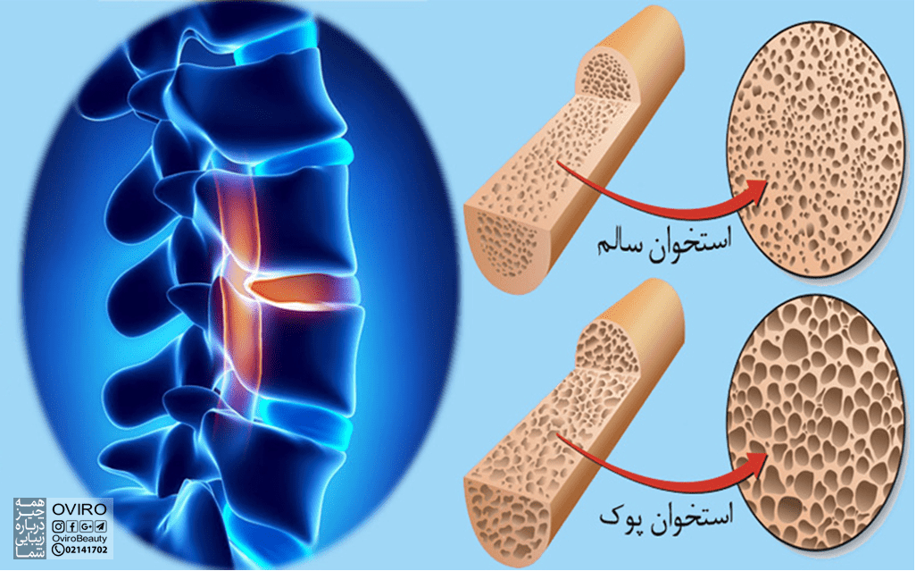 آزمایش تراکم استخوان چگونه است؟ آمادگی قبل از آن | تفسیر نتایج سنجش تراکم استخوان | علت