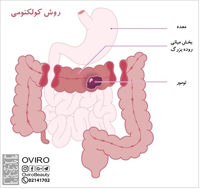 کولکتومی چیست؟ انواع - عوارض - مراقبت های بعدی | عمل جراحی برداشتن روده بزرگ