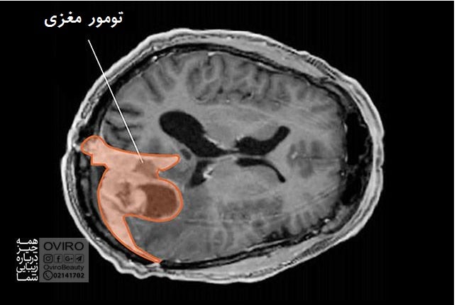 مننژیوم چیست؟ انواع - علائم - علت - درمان - تشخیص - چشم انداز | تومور مننژیوم